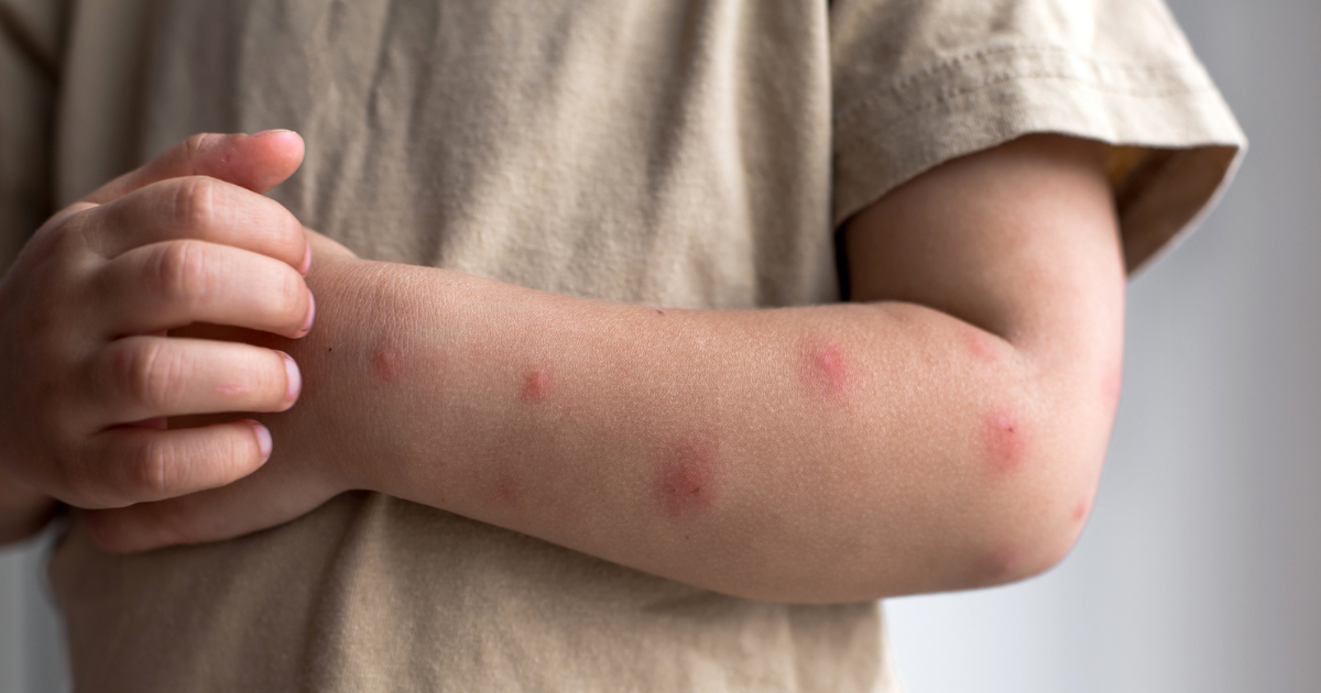 Close-up photo of a child’s forearm with several raised pink hives and mild redness, natural indoor light