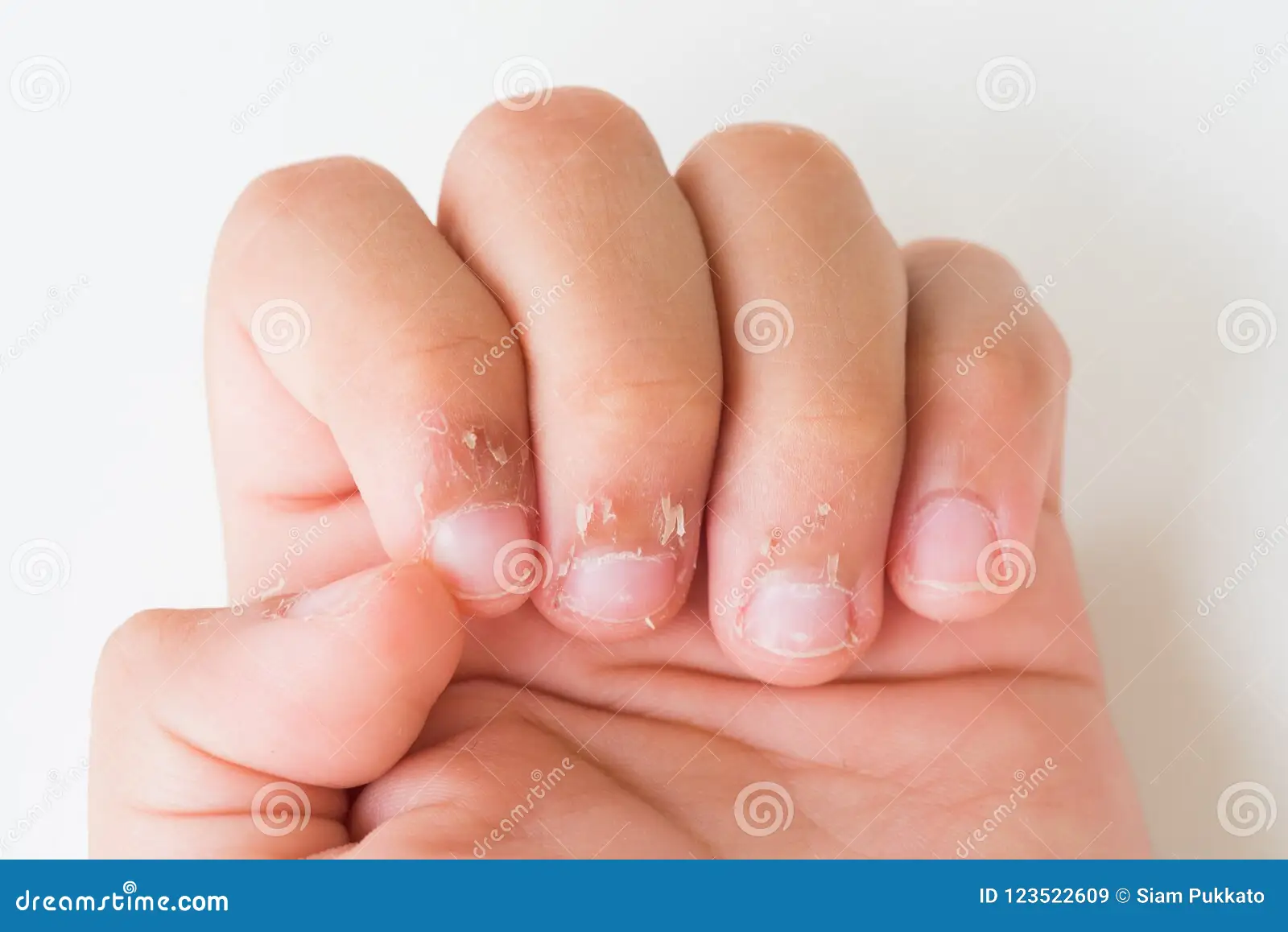 Close-up photograph of a toddler's hands with slightly dry skin around the nails while resting on a parent’s lap, warm indoor light