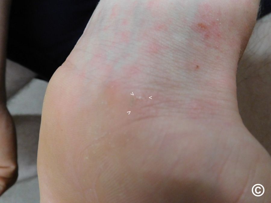 Toddler ankle and top of foot with scattered small red bumps and mild redness consistent with an itchy rash